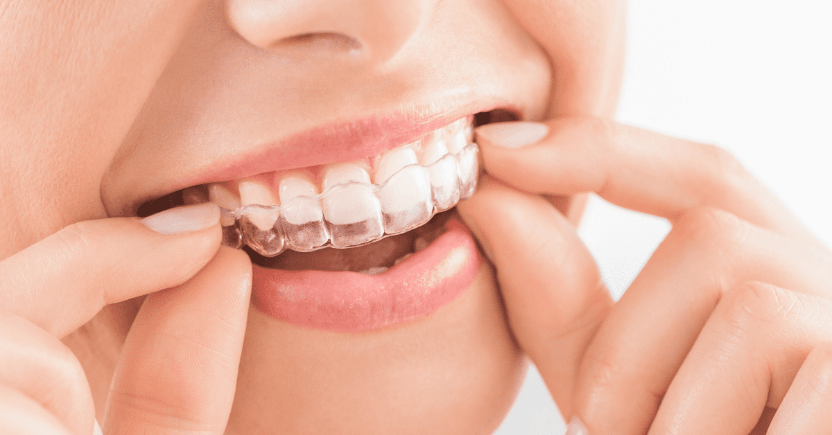 Invisalign For 10YearOlds Northern Virginia Orthodontics