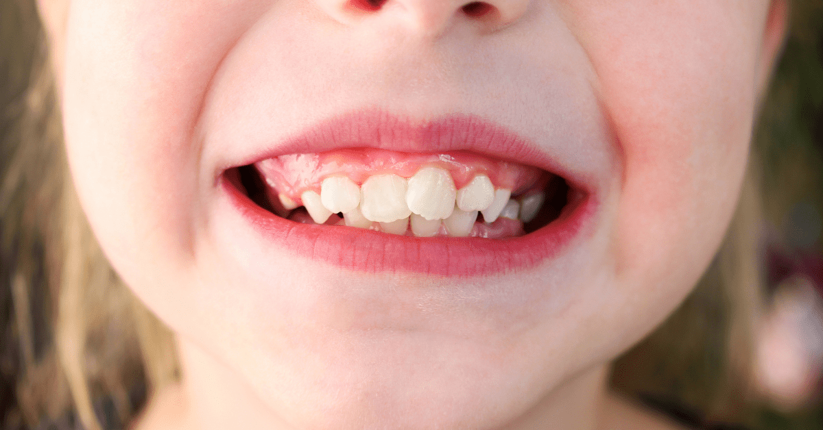 Invisalign First - Permanent & Baby Teeth