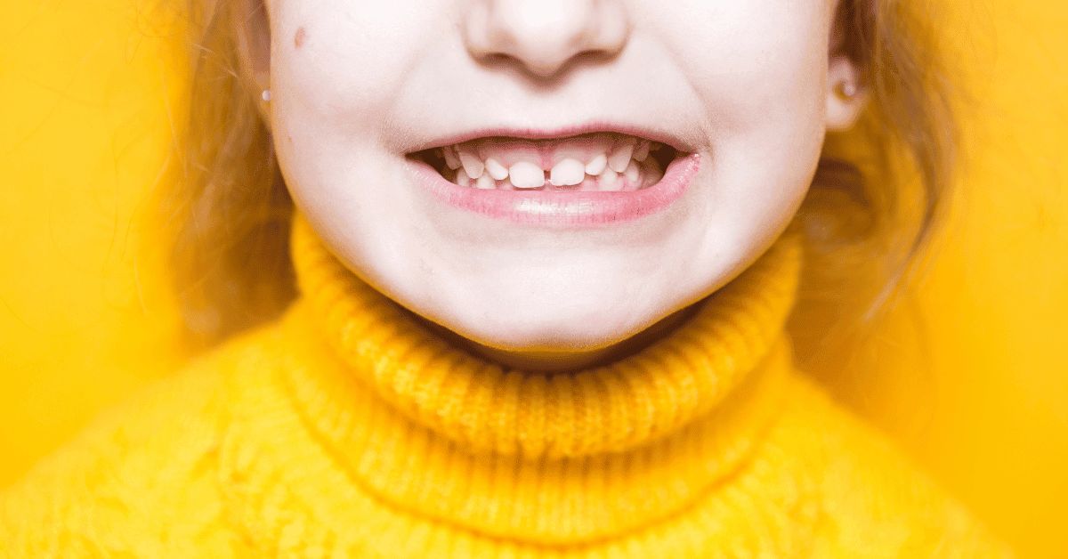 Invisalign Treatable Cases: Overbite