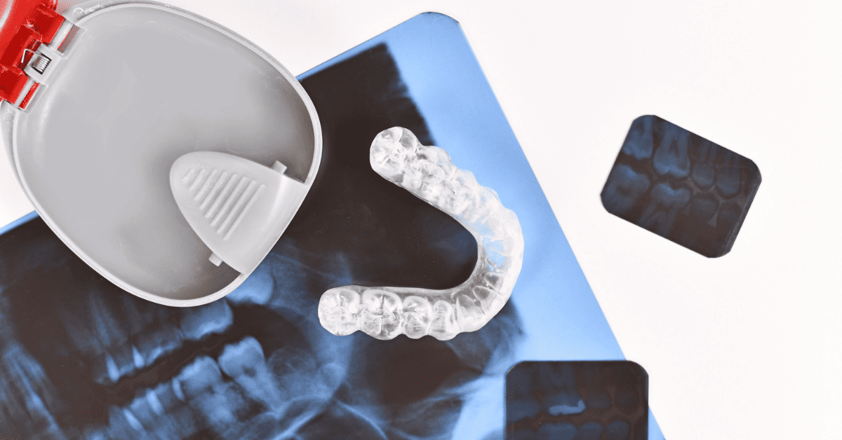 Invisalign Treatable Cases: Underbite