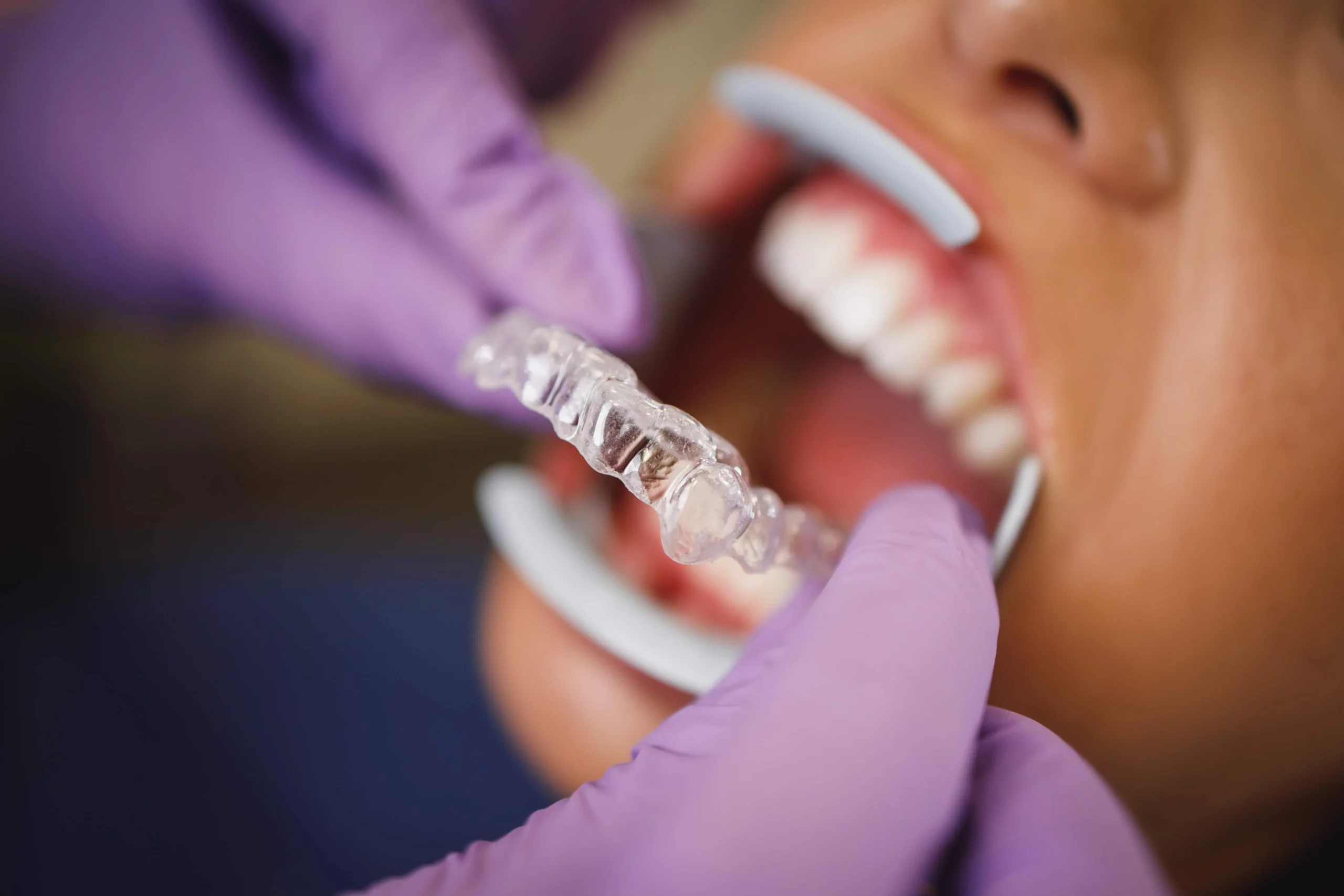 Invisalign First - Permanent & Baby Teeth